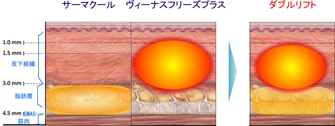 トリプルリフトの効果
