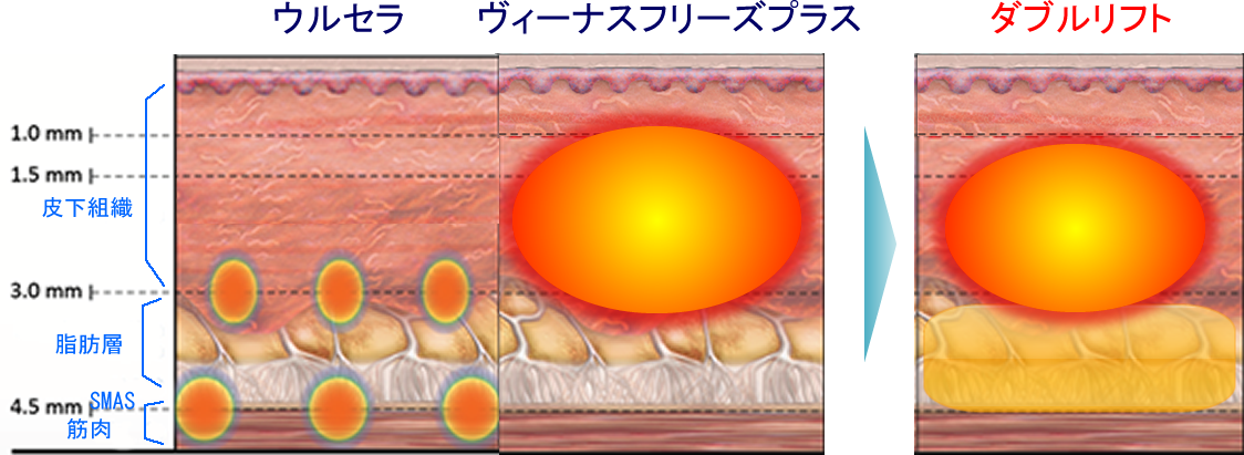 ダブルリフトの効果