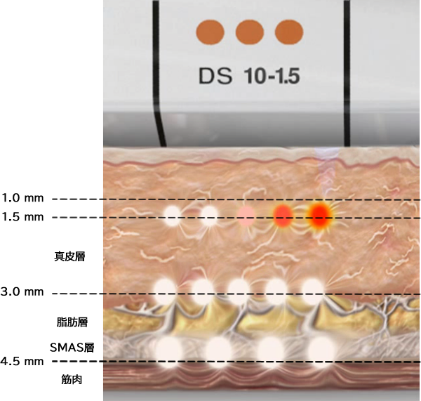1.5mm トランスデューサー