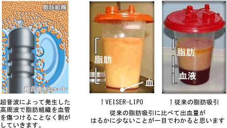 吸引 ベイザー 脂肪