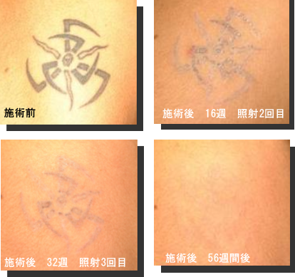 最新pico Yagレーザーによる刺青除去 美容外科 美容皮膚科 形成外科 共立美容外科仙台院