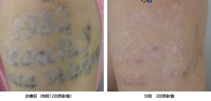 最新Pico-Yagレーザーによる刺青除去 | 美容外科・美容皮膚科・形成外科 共立美容外科仙台院