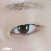 施術前 before
