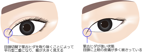 目頭切開で蒙古ヒダを取り除くことによって並行二重になり、眼が大きく見える　蒙古ヒダが強い状態 目頭に上瞼の皮膚が多くかぶさっている