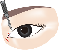 1.目頭部分の蒙古襞の部分の内外にかけてW字型にメスを入れます