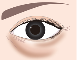 １．目の下の膨らみは眼窩脂肪が原因です。