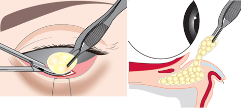 ３．目の下の眼窩脂肪を取り除きます。傷口は小さく目立ちません。