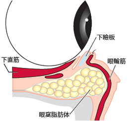１．目の下の膨らみの原因である眼窩脂肪の除去と皮膚タルミをそれぞれ解消します。