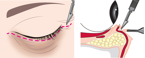 ２．下睫のキワのあたりをメスで切ります。