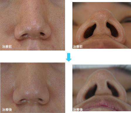 小鼻縮小 美容外科 美容皮膚科 形成外科 共立美容外科仙台院