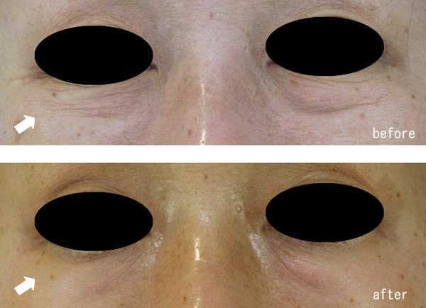 お手軽タルミ治療 レーザーリフティング 目元は特に効果的 美容外科 美容皮膚科 形成外科 共立美容外科仙台院