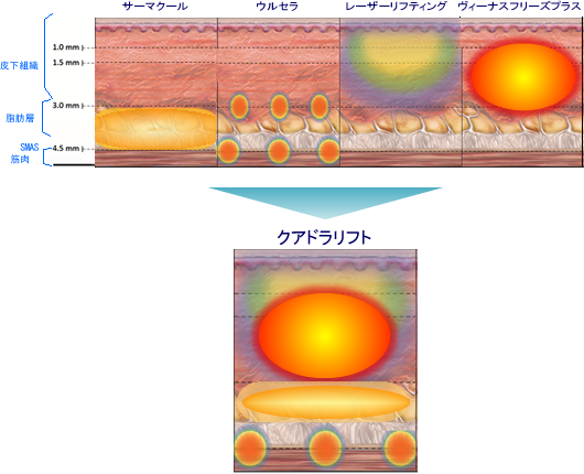 クアドラリフトの効果