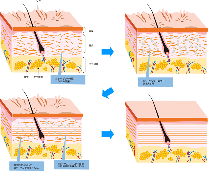 コラーゲンブースターによるコラーゲンの産生