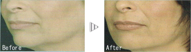 before after