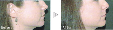 before after