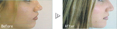 before after