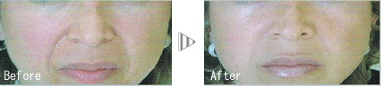 before after