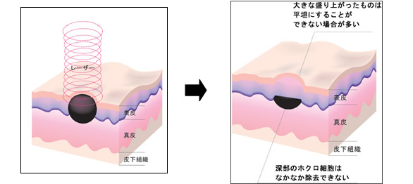 料金 ほくろ 除去