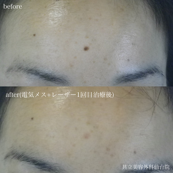 Before