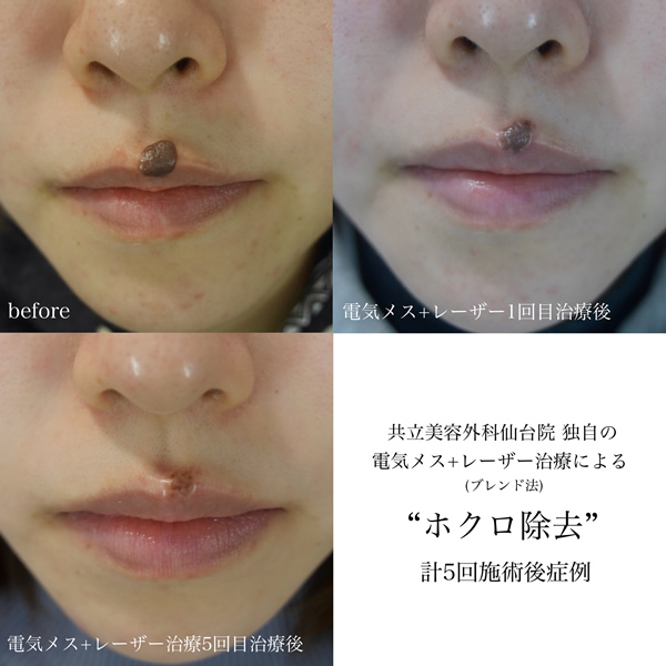 Before