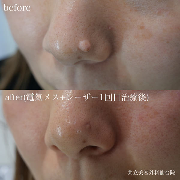 Before