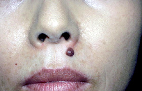 ホクロ除去 美容外科 美容皮膚科 形成外科 共立美容外科仙台院