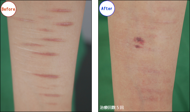 傷痕 リストカット修正 美容外科 美容皮膚科 形成外科 共立美容外科仙台院