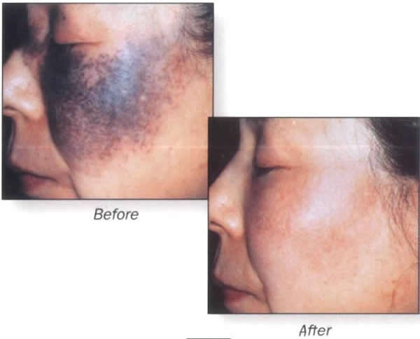 アザ 美容外科 美容皮膚科 形成外科 共立美容外科仙台院