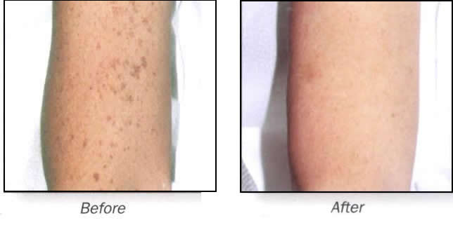 シミ 色素沈着の除去 美容外科 美容皮膚科 形成外科 共立美容外科仙台院